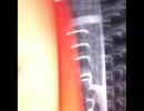 ムカついてiPhoneの液晶を割った