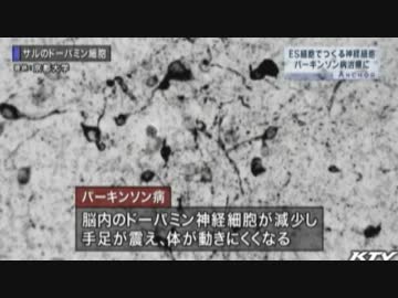 ＥＳ細胞がパーキンソン病治療に　京都大学の研究チームが発表