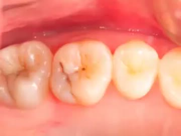 とっても小さなむし歯、と思っていたら実は中では、、、前編