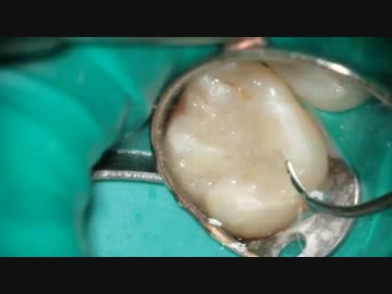 とっても小さなむし歯、と思っていたら実は中では、、、後編