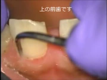 歯医者さんで歯石除去