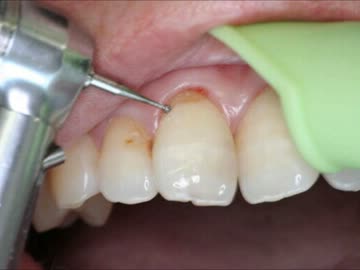 【閲覧注意】とっても小さな虫、と思っていたら実は中では、、、蝸牛編