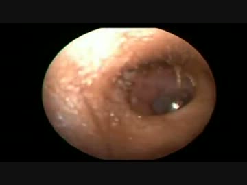 耳からダイヤモンド　【Dr.Vetri】