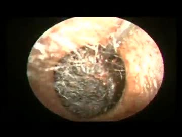 難しすぎる耳掃除　【Dr.Vetri】