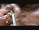 鼻から大量の角栓を絞り出してる様子