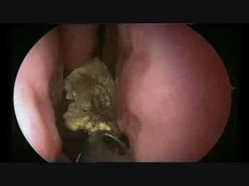 鼻石症の鼻　【Dr.Janakiram】