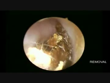 乾燥耳垢の除去　【Dr.Dhakeswar】