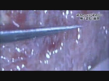 産みたいのに産めない ～卵子老化の衝撃～ (02 of 02)