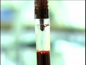 被曝治療83日間の記録 ～東海村臨界事故～(高画質版) (04 of 04)