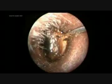 ゴム状耳垢　【Dr.Vetri】