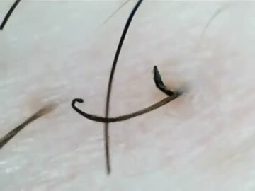 埋没毛救出動画詰め合わせ