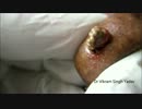 【グロ注意】粉瘤・初めての色合い【どうしてこうなった】