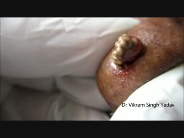 【グロ注意】粉瘤・初めての色合い【どうしてこうなった】