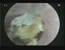 Ear cleaning in VN 4.mp4