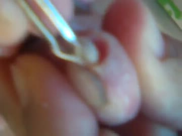 寄生虫　スナノミ