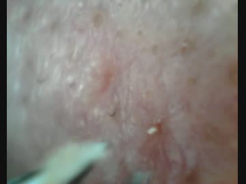 毎日のお仕事　角栓　いちごはな　acne　keratotic plug.mp4