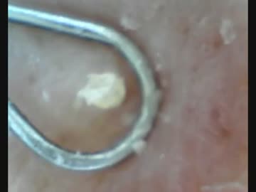 大きめの角栓とり acne　spots　zits　keratotic plug.mp4