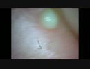 ニキビ　動画　③