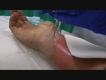 自作エンジン試験運転で火傷した（グロ注意：海外）