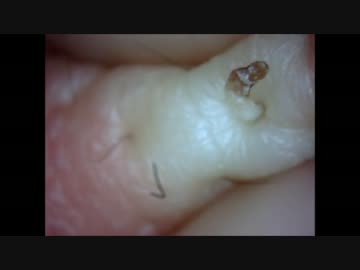 必見！巨大角栓を収穫！！！