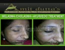 Melasma Treatments : Ayurvedic Skin Specialist - Dr. Amit Dutta