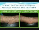 Lichen Planus Treatments : Ayurvedic Skin Specialist - Dr. Amit Dutta