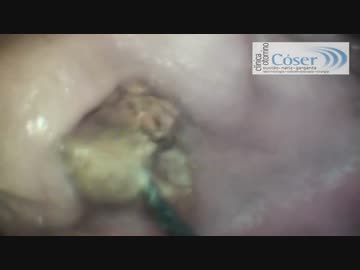 巨大すぎる耳垢