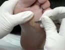 [魚の目] プロフェッショナルによる魚の目除去 [PODOLOGIA PROFESIONAL EDEPACH]