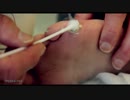 [魚の目] Dr. Paul による液体窒素での魚の目治療 [GIANT WART FREEZING]