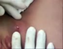 【グロ注意】普通の粉瘤搾り【大したことない】