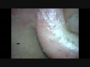 鼻から寄生虫が出る（寄生虫とは言っていない）