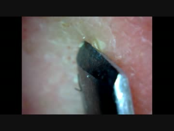 角栓の後ろに隠れていた脂肪