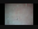 がっかりニキビ（使命感）
