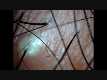 ニキビ潰した結果体液が・・・