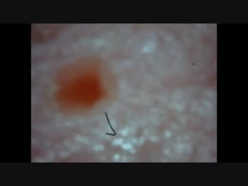 巨大な毛穴が閉じる様子を撮影に成功！