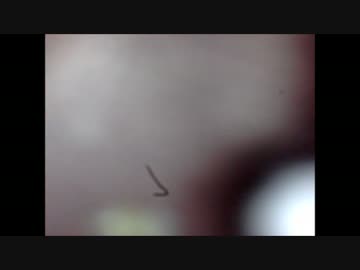 毛穴の形そのまんまの黒ニキビを徹底観察