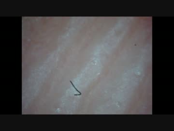 多汗症の男性の手から漏れだす液体500倍観察