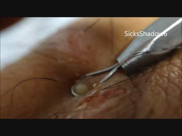 『ペチッっ』と音が鳴って潰れるニキビ　いい音だ