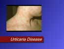 URTICARIA(HIVES) Ayurvedic Treatment : ayursudha.com
