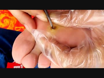 足の裏に出来たウィルス性イボの芯をぼじくり取る