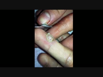 指に出来たウィルス性イボを芯ごと除去してみた！！