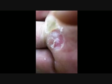 掌のイボ 皮剥き ポッカリ穴