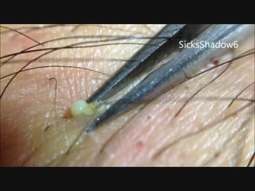 ニキビを毛ごと抜き潰すパート２ニュル