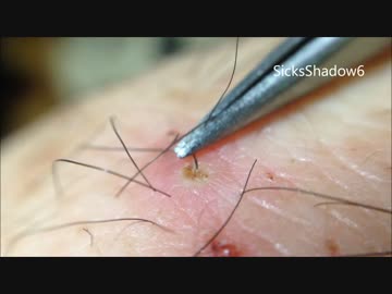 ニキビを毛ごと抜き潰すパート３ニュル