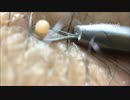立派に育った毛穴ニキビ(毛嚢炎)を押し出し　ニュルッ！！