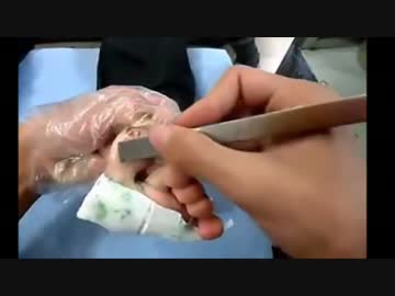 大量発生した尋常性疣贅(イボ) 除去