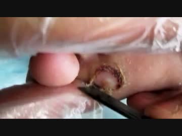 シンプルに魚の目を削ってみたよ！！！！