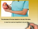 How Long Does It Take To Pass A Kidney Stone