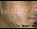 Skin specialist Samrala  Skin treatment in Samrala.