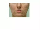 How to Get Rid of Scar Tissue